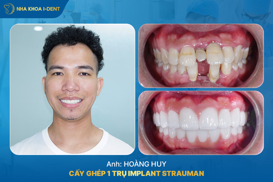 răng thưa - Nha khoa I-Dent