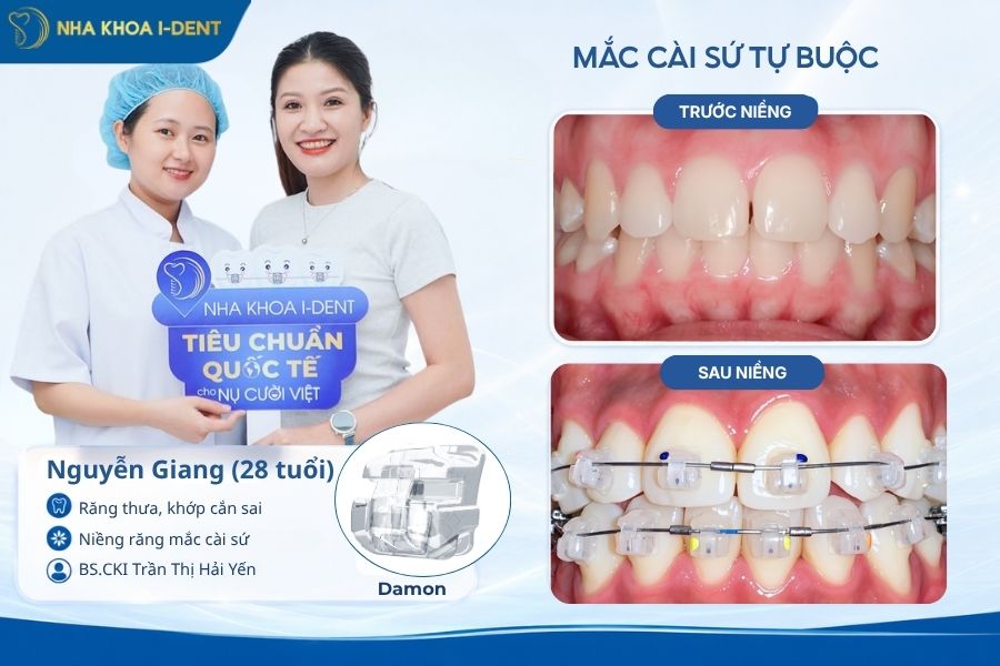 chi phí niềng răng mắc cài tự buộc