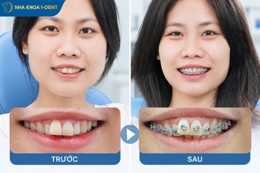 giá niềng răng mắc cài tự đóng