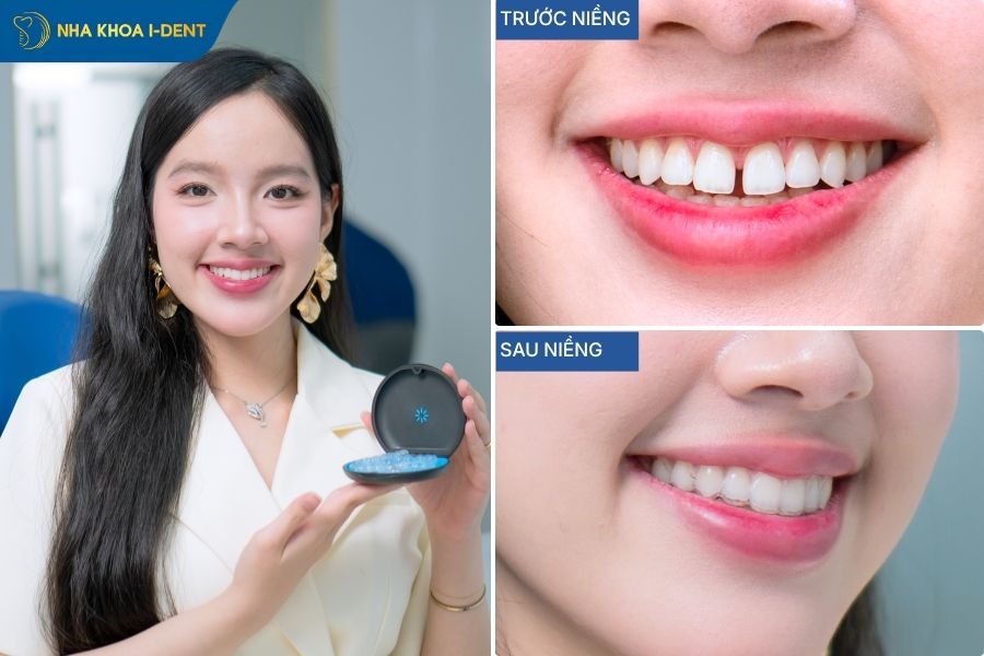 ảnh niềng răng trong suốt