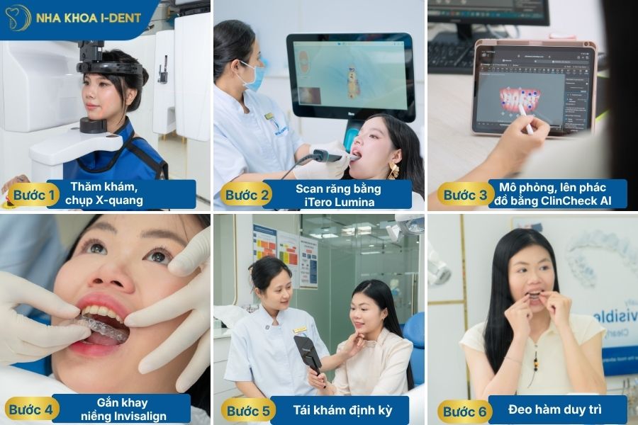 hình ảnh niềng răng trong suốt 6 bước