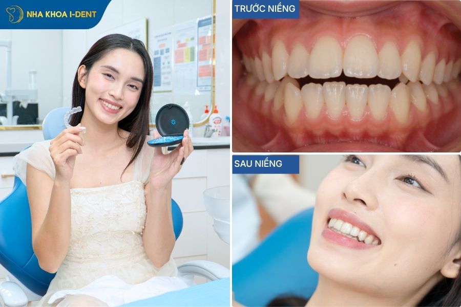 hình niềng răng trong suốt