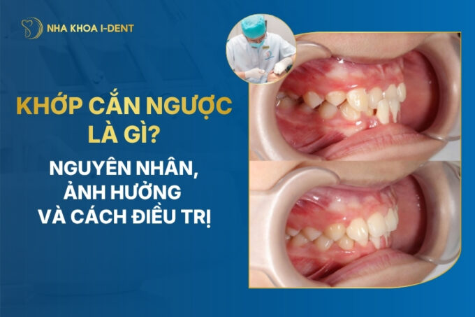 khớp cắn ngược