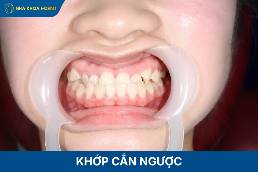 khớp cắn ngược là gì
