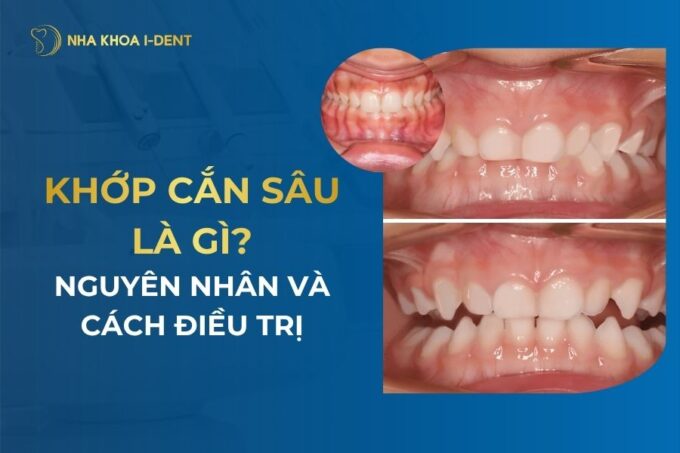 Khớp cắn sâu là gì? Nguyên nhân và cách điều trị