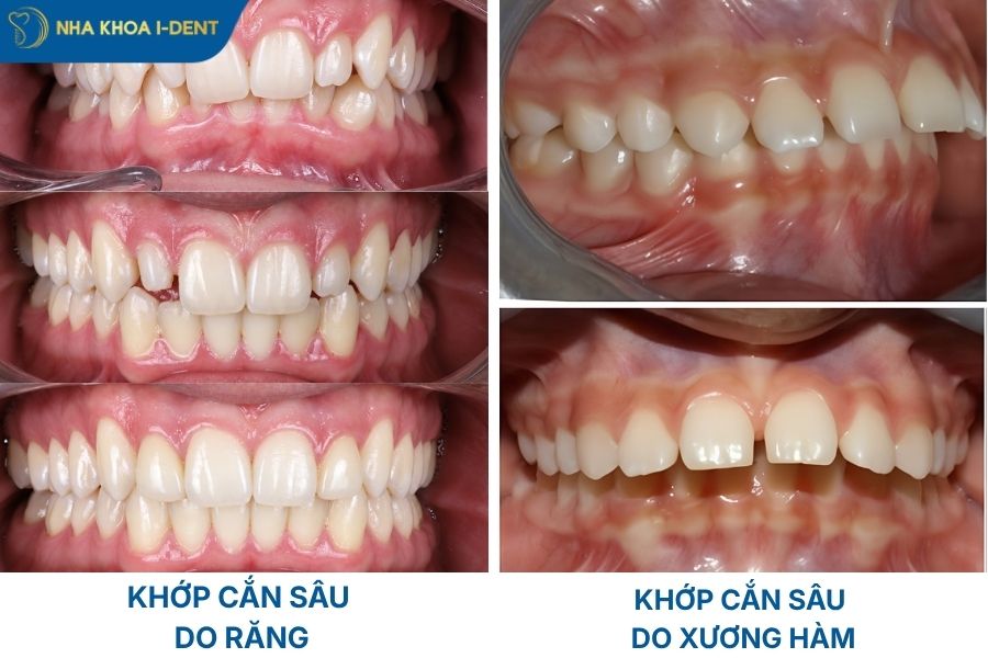 khớp cắn sâu là sao