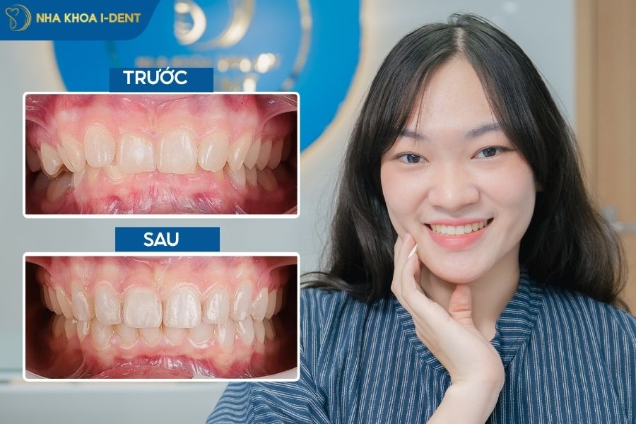 cách khắc phục khớp cắn sâu