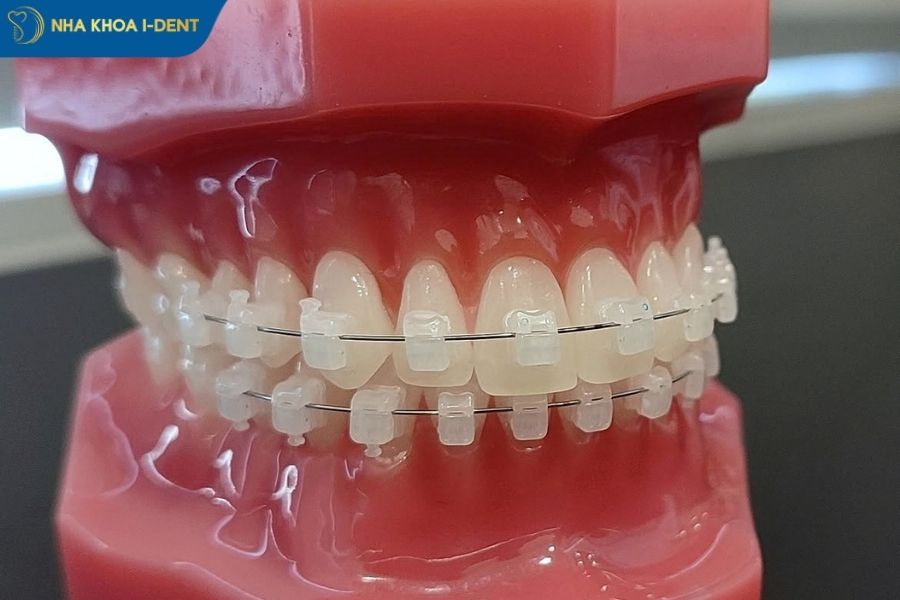 mắc cài sứ tự buộc