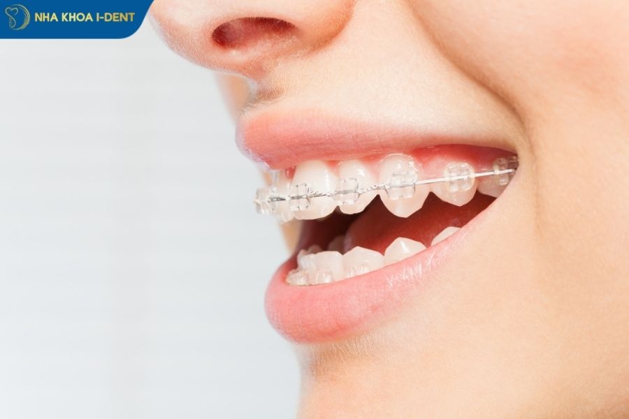 mắc cài sứ - Nha khoa I-Dent