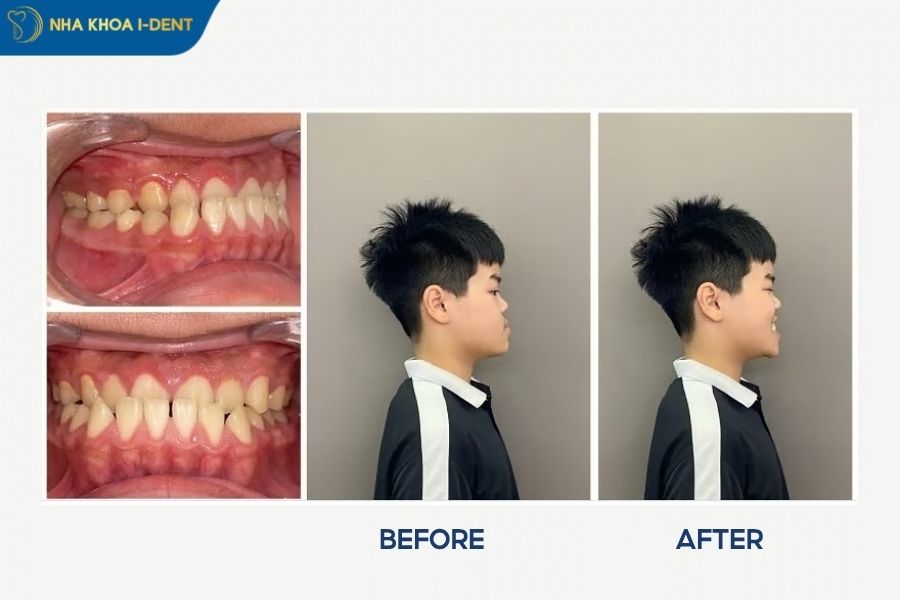 móm niềng răng - Nha khoa I-Dent