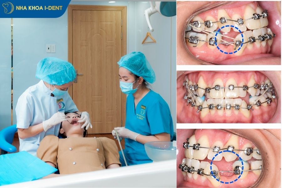 nhổ răng để niềng có ảnh hưởng gì không