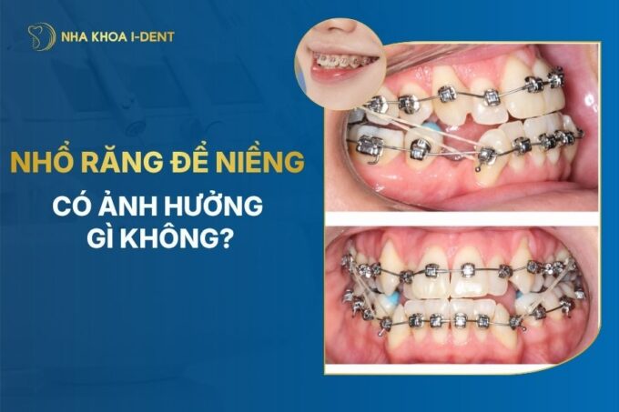 Nhổ Răng Để Niềng Có Ảnh Hưởng Gì Không?