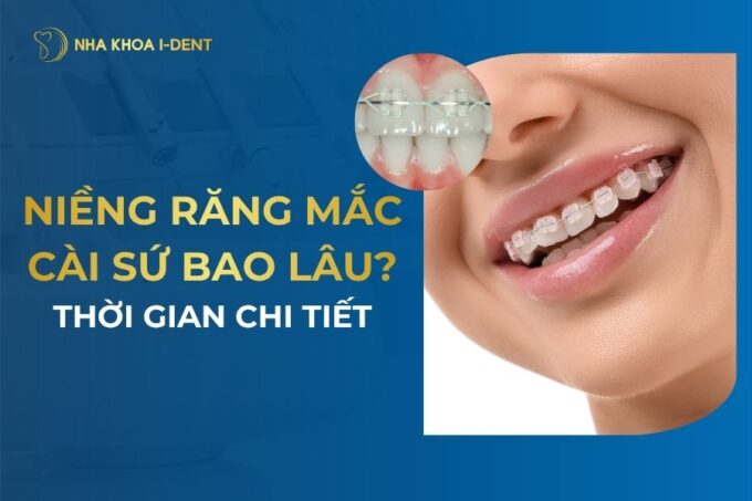 Niềng Răng Mắc Cài Sứ Mất Bao Lâu? Thời Gian Chi Tiết