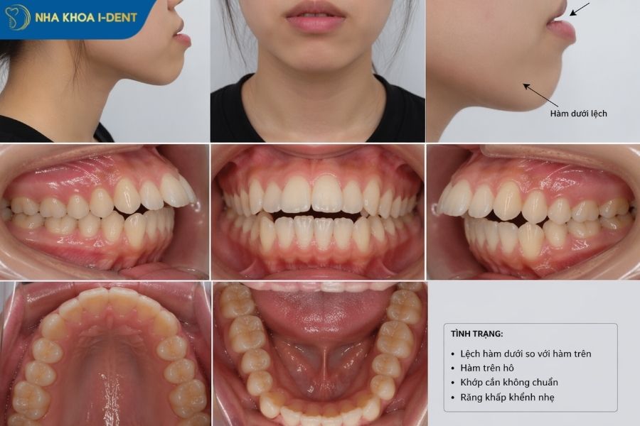 niềng răng mắc cài sứ bao lâu - Nha khoa I-Dent