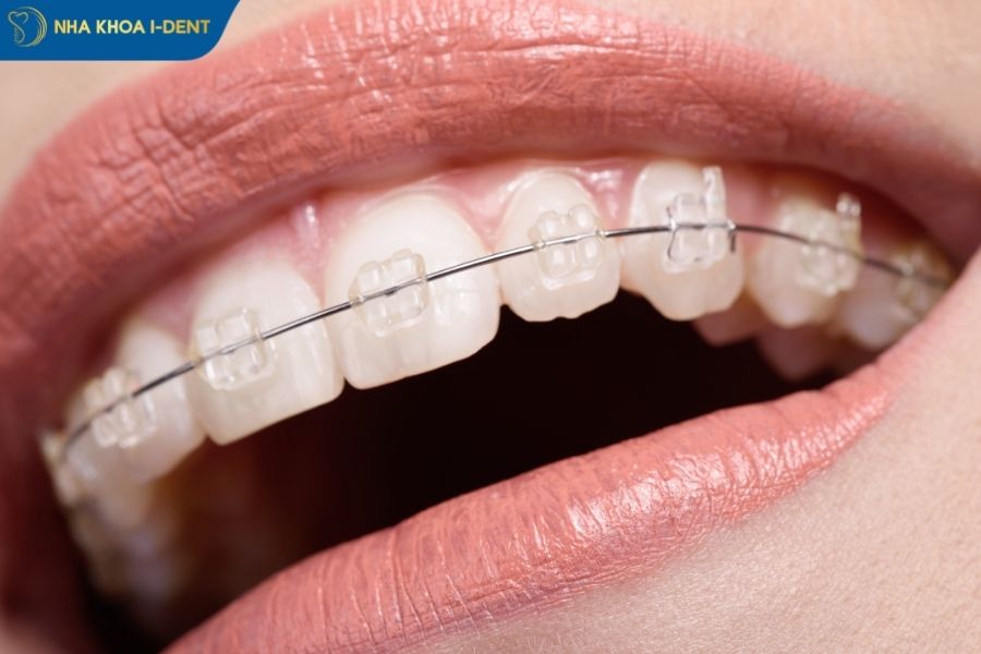niềng răng mắc cài sứ là gì - Nha khoa I-Dent