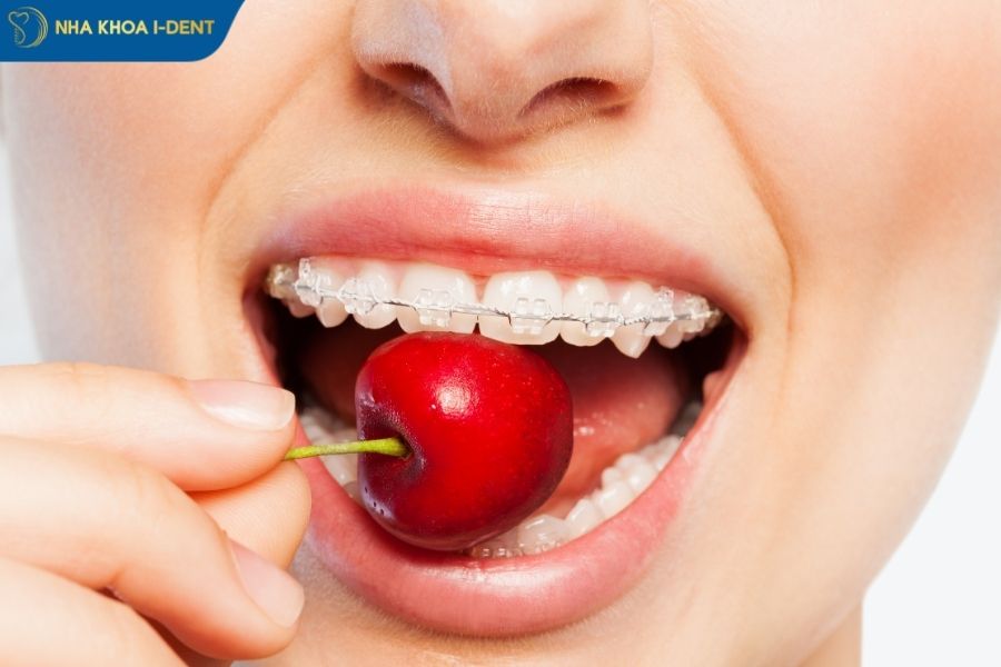 niềng răng mắc cài sứ bao lâu - Nha khoa I-Dent