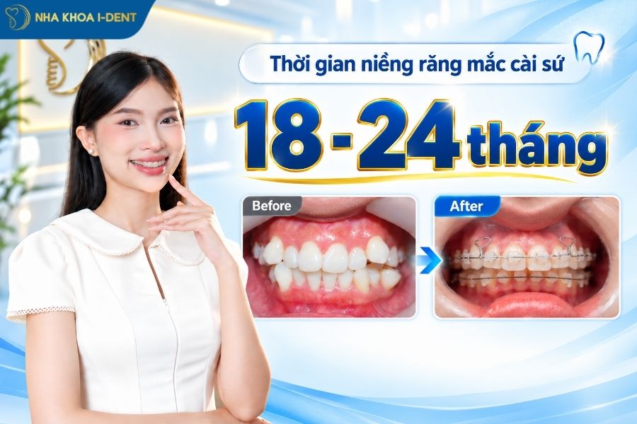 niềng răng mắc cài sứ mất bao lâu - Nha khoa I-Dent