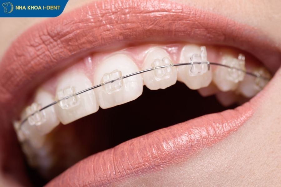 niềng răng mắc cài sứ trong bao lâu - Nha khoa I-Dent