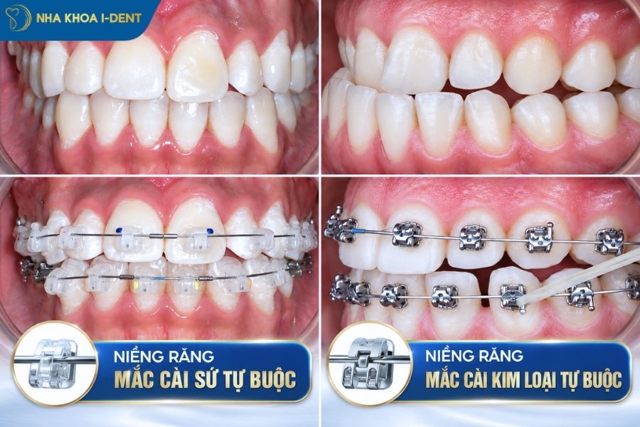 niềng răng mắc cài sứ tự buộc giá bao nhiêu