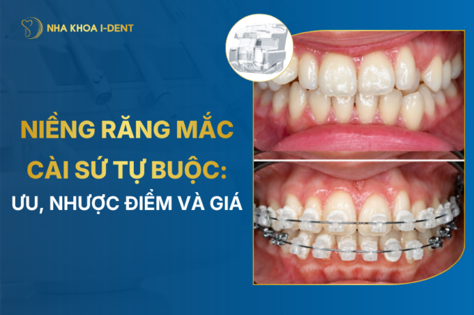 Niềng Răng Mắc Cài Sứ Tự Buộc: Ưu, Nhược Điểm Và Chi Phí