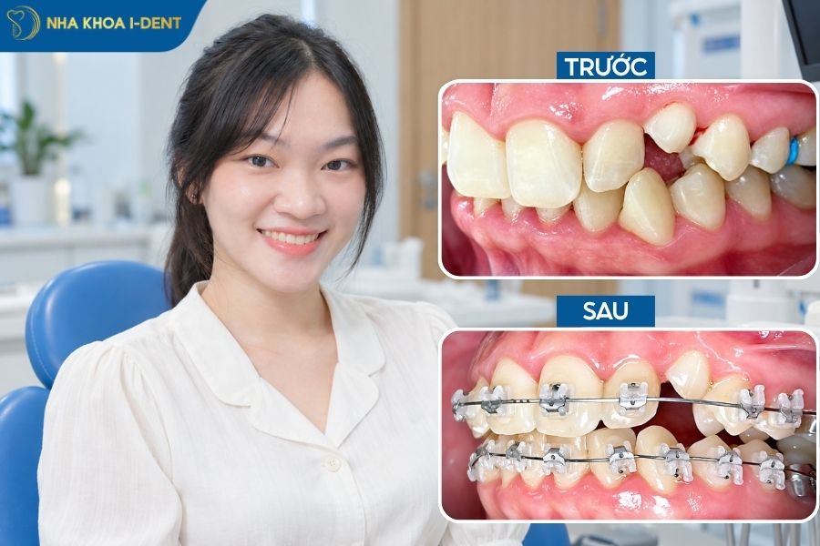 niềng răng mắc cài sứ tự đóng