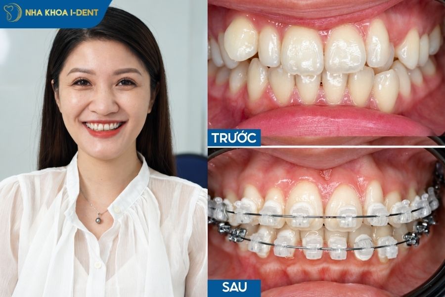 niềng răng mắc cài sứ tự buộc