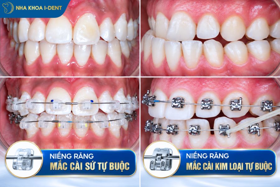 niềng răng mắc cài tự buộc giá bao nhiêu