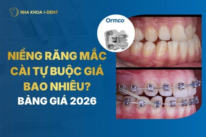 Niềng răng mắc cài tự buộc giá bao nhiêu? Giá niềng T10/2026