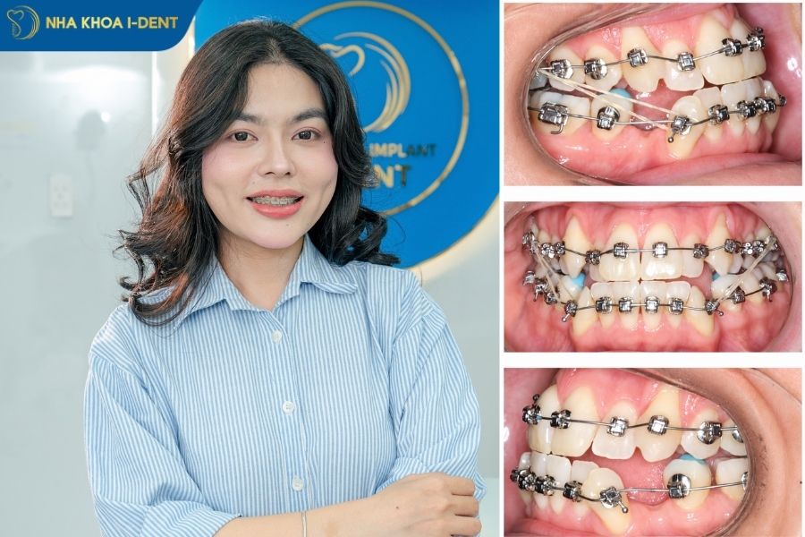niềng răng mắc cài tự đóng giá bao nhiêu