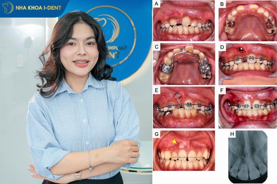 niềng răng mọc ngược