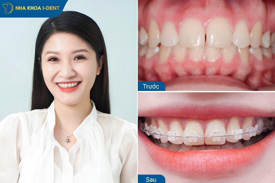 niềng sứ - Nha khoa I-Dent