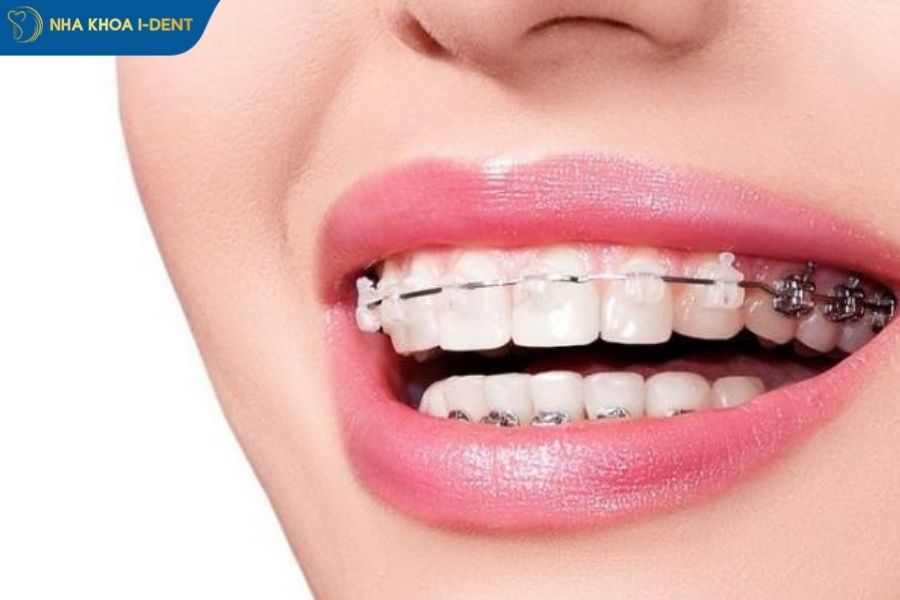 niềng răng sứ - Nha khoa I-Dent