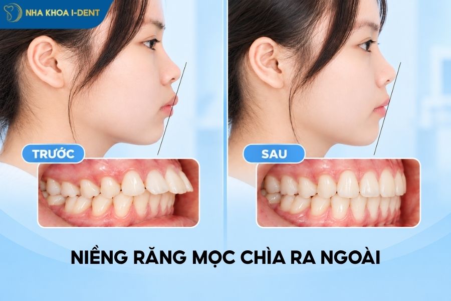 răng bị chìa