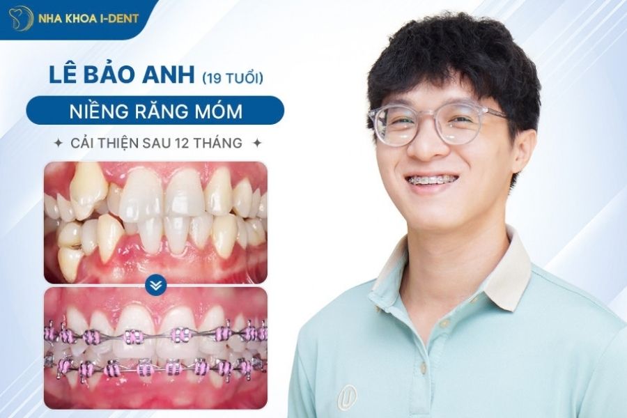 răng bị móm phải làm sao - Nha khoa I-Dent