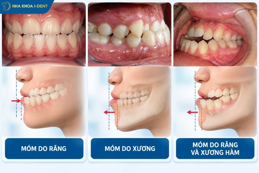 răng bị móm - Nha khoa I-Dent