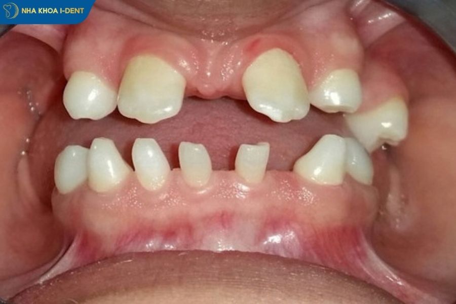 răng bị thưa dần phải làm sao - Nha khoa I-Dent