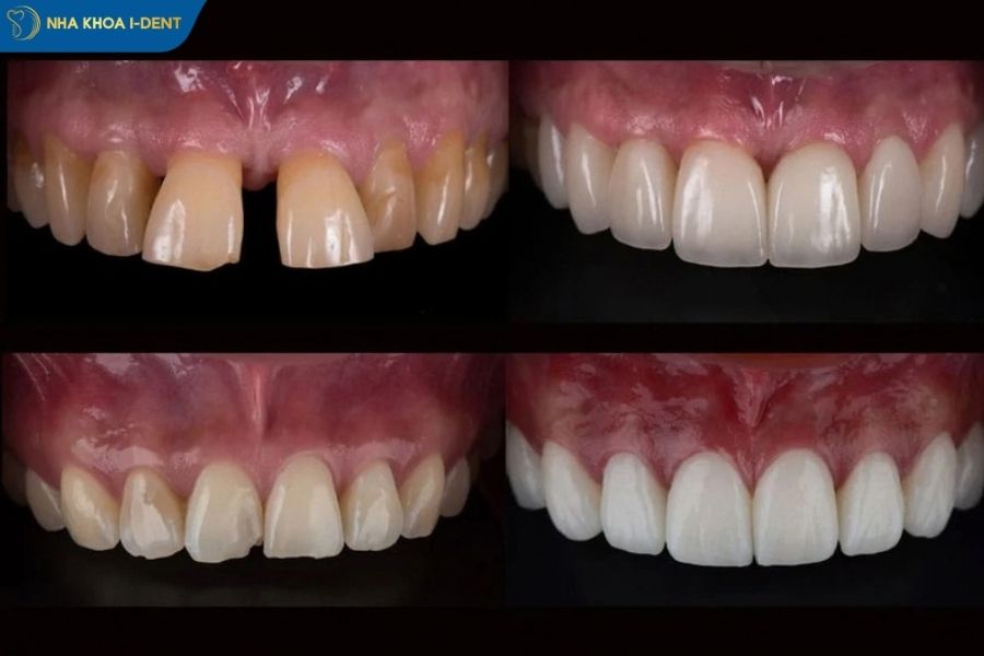 răng thưa - Nha khoa I-Dent