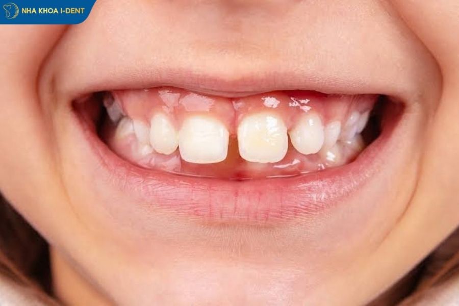 răng bị thưa phải làm sao - Nha khoa I-Dent