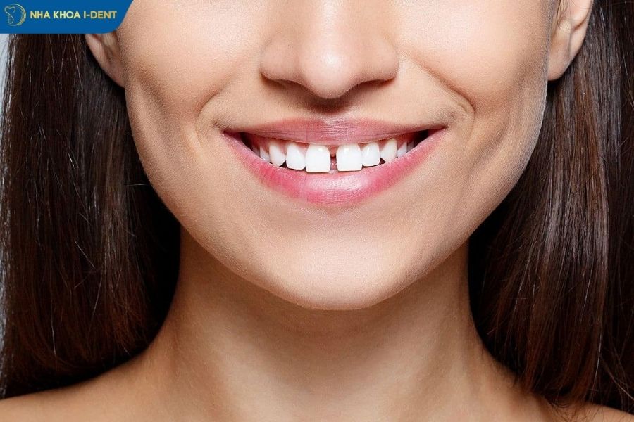 răng thưa - Nha khoa I-Dent