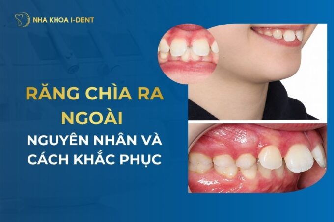 Răng chìa ra ngoài: Nguyên nhân và cách khắc phục