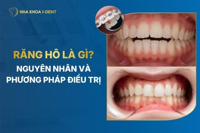 răng hô