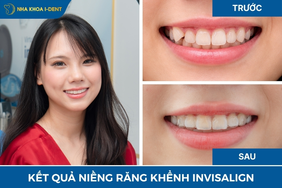 răng khểnh là sao