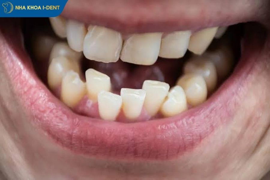 răng mọc lệch lạc