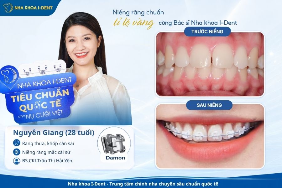răng thưa - Nha khoa I-Dent