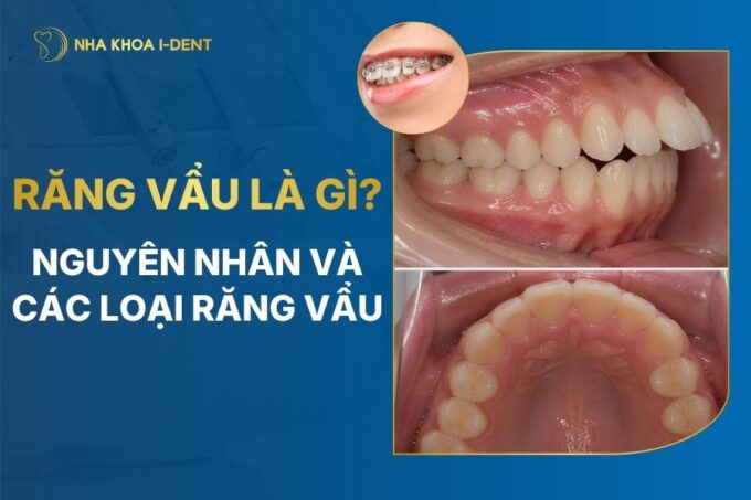 răng vẩu