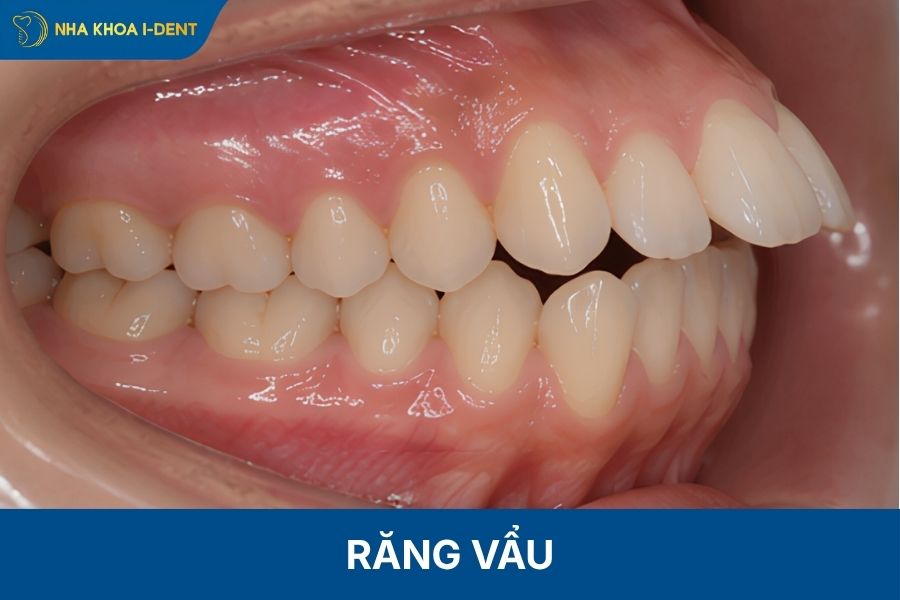 răng vẩu là gì