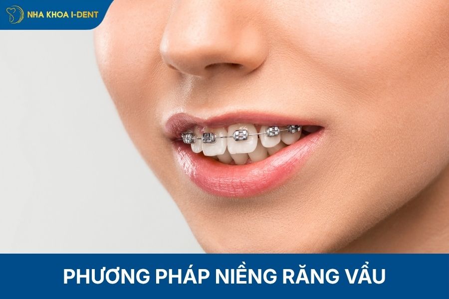 răng vẩu nặng