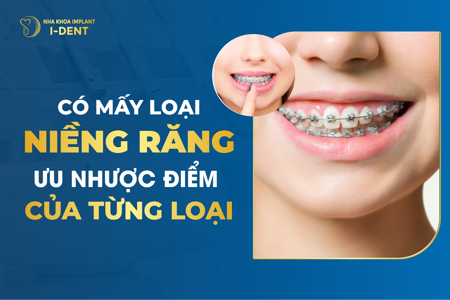 Có Mấy Loại Niềng Răng? Ưu Nhược Điểm Của Từng Loại?