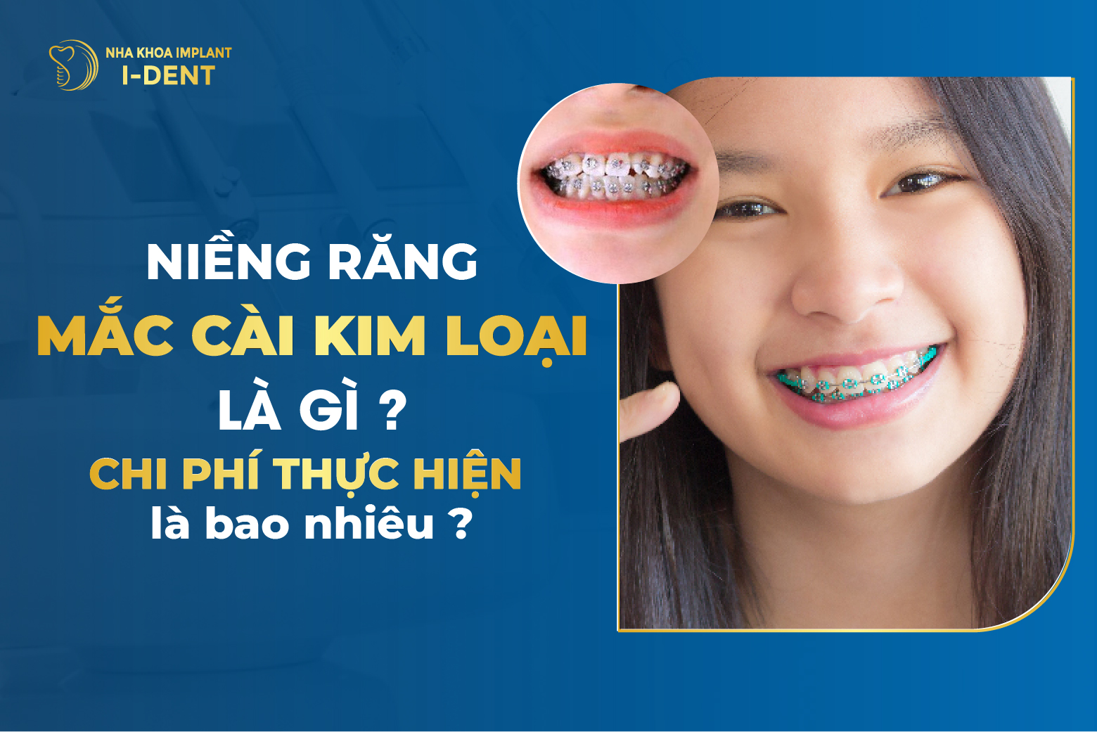 [T6/2026] Niềng răng mắc cài kim loại giá bao nhiêu?