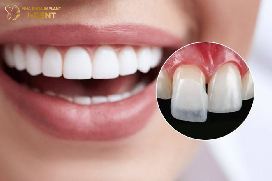 dán veneer răng có tốt không